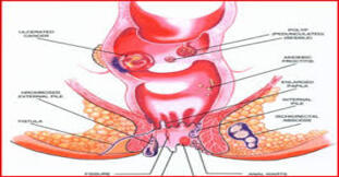 Arsha (Hemorrhoids)