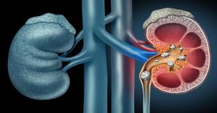 Ashmari (Kidney Stones)